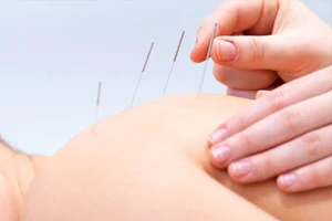 Chiropractic Amarillo TX Acupuncture