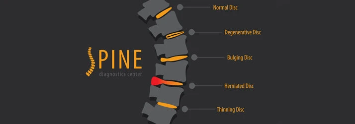 Chiropractic Amarillo TX Degenerative Disc